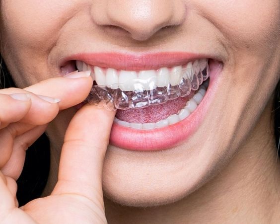 Invisible Teeth Aligners in Gurgaon: A Clear Choice for a Confident Smile